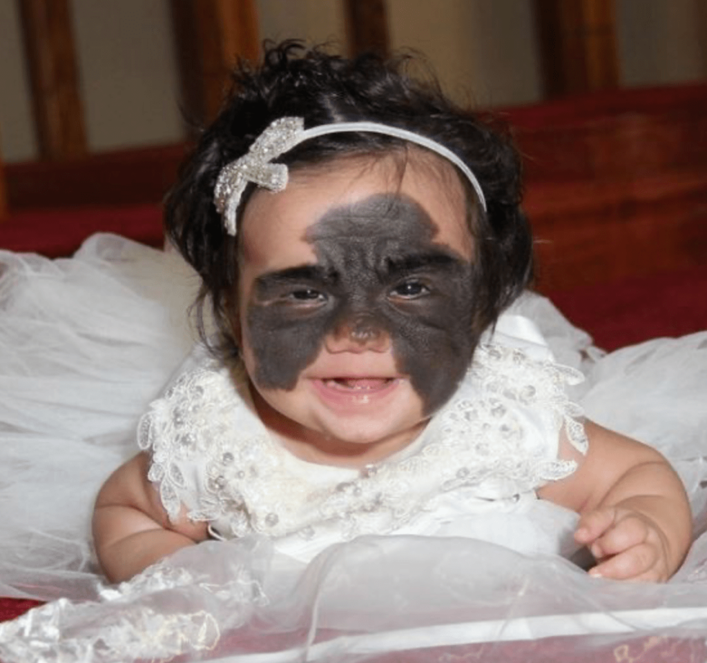 After groundbreaking surgery, a girl has finally had her ‘Batman’ birthmark removed.