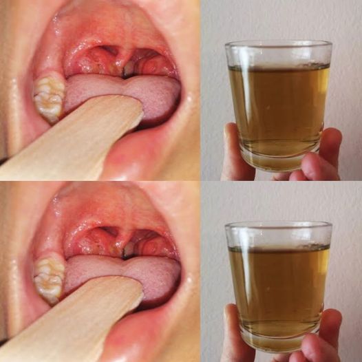 Discover the Power of Natural Remedies for Soothing Sore Throats