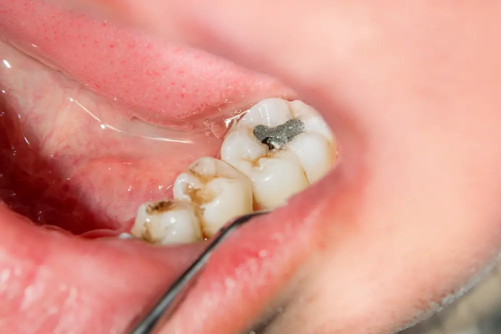 Turning Back Time on Tooth Cavities: Home Strategies to Halt Decay