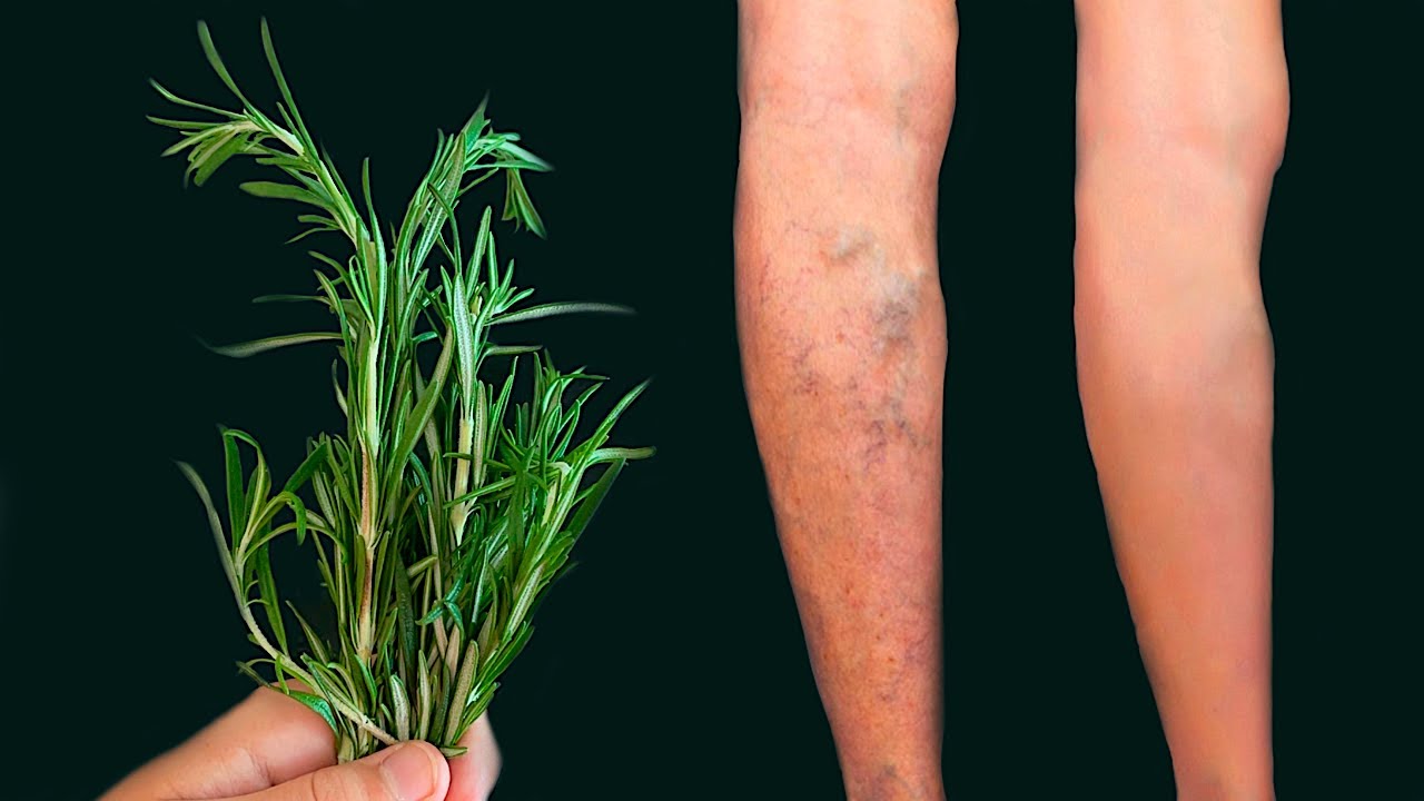 Rosemary and Laurel: Nature’s Answer to Varicose Veins