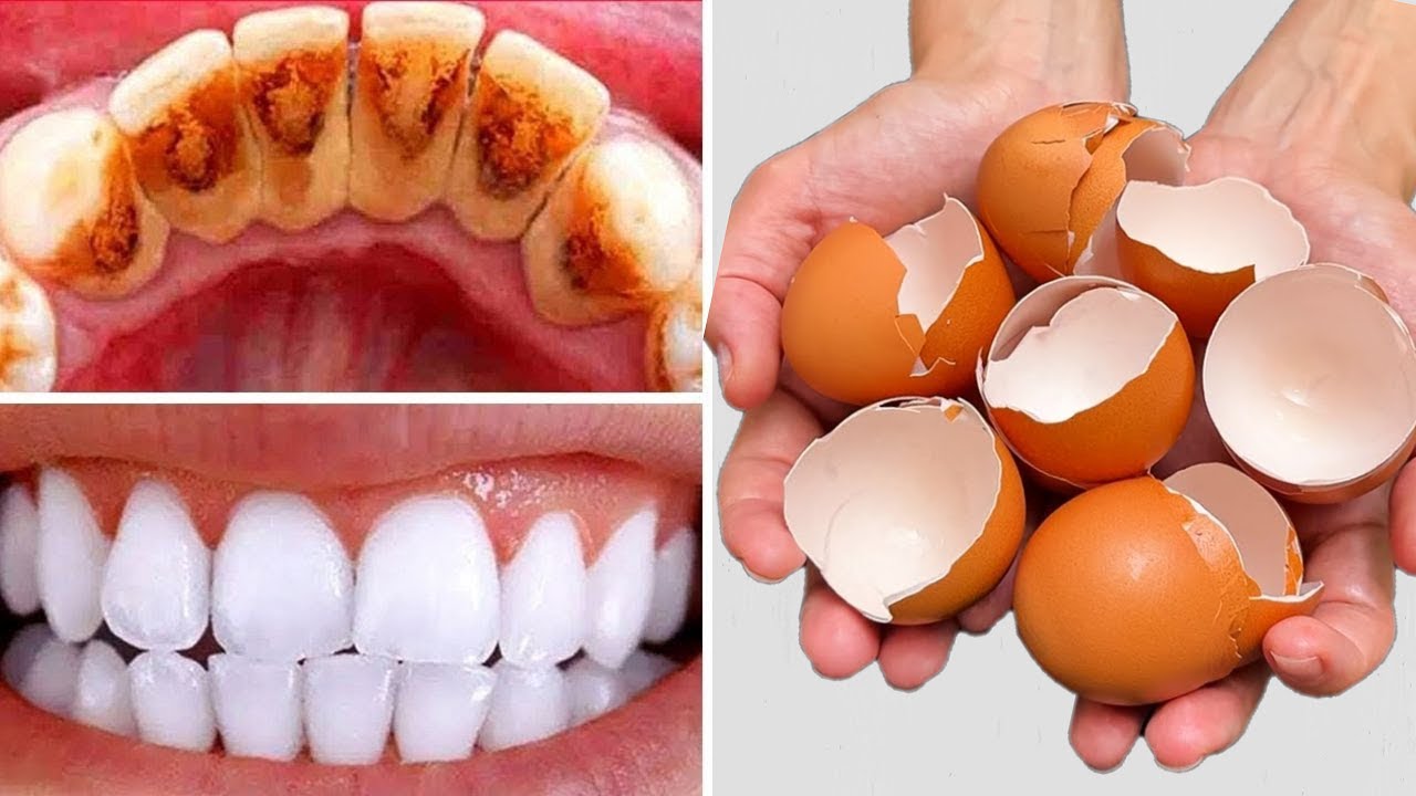 The Bright Smile Secret: Eggshell Teeth Whitening Wonder