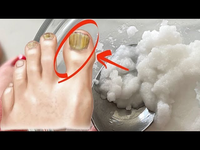 Baking Soda: The Unsung Hero in the Fight Against Nail Fungus