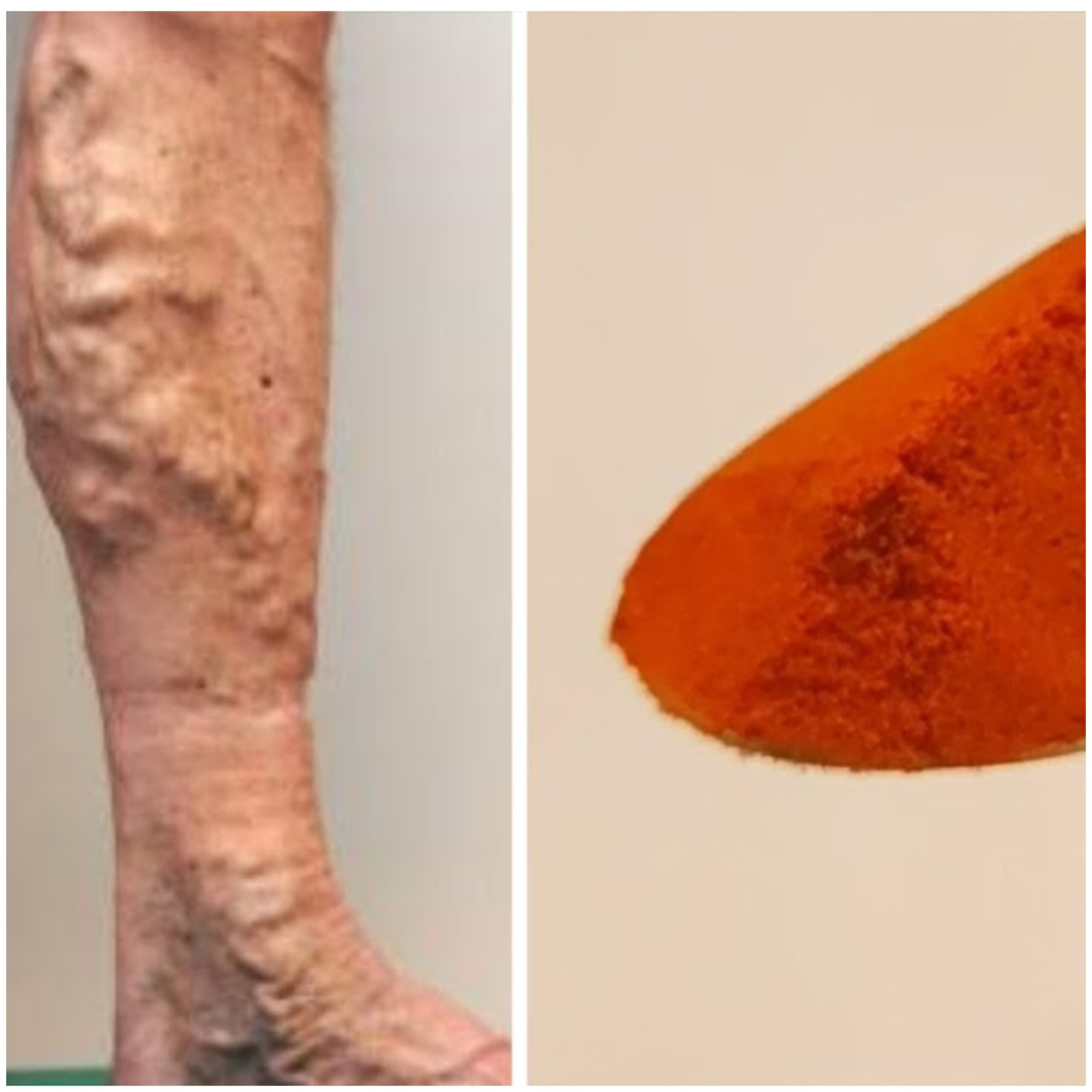 Wave Goodbye to Varicose Veins and Poor Circulation with Cayenne Pepper: The Natural Wonder