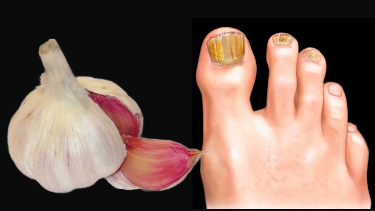 Garlic: The Mighty Nail Fungus Eraser You Didn’t Know You Had