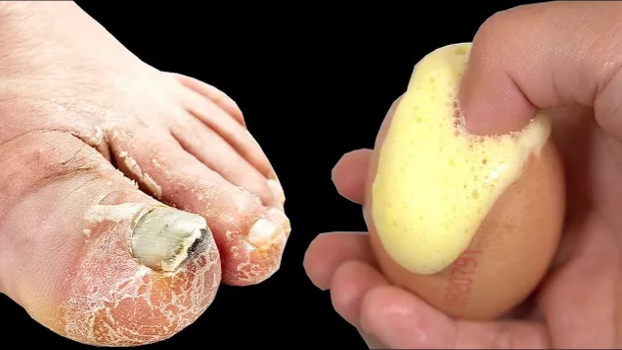 Effortless and Economical Remedy for Toenail Fungus: Under $1 and Under 1 Minute!