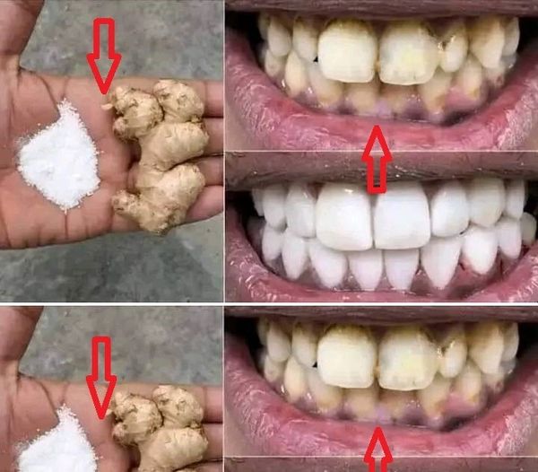 The Best Method for Whitening Your Teeth