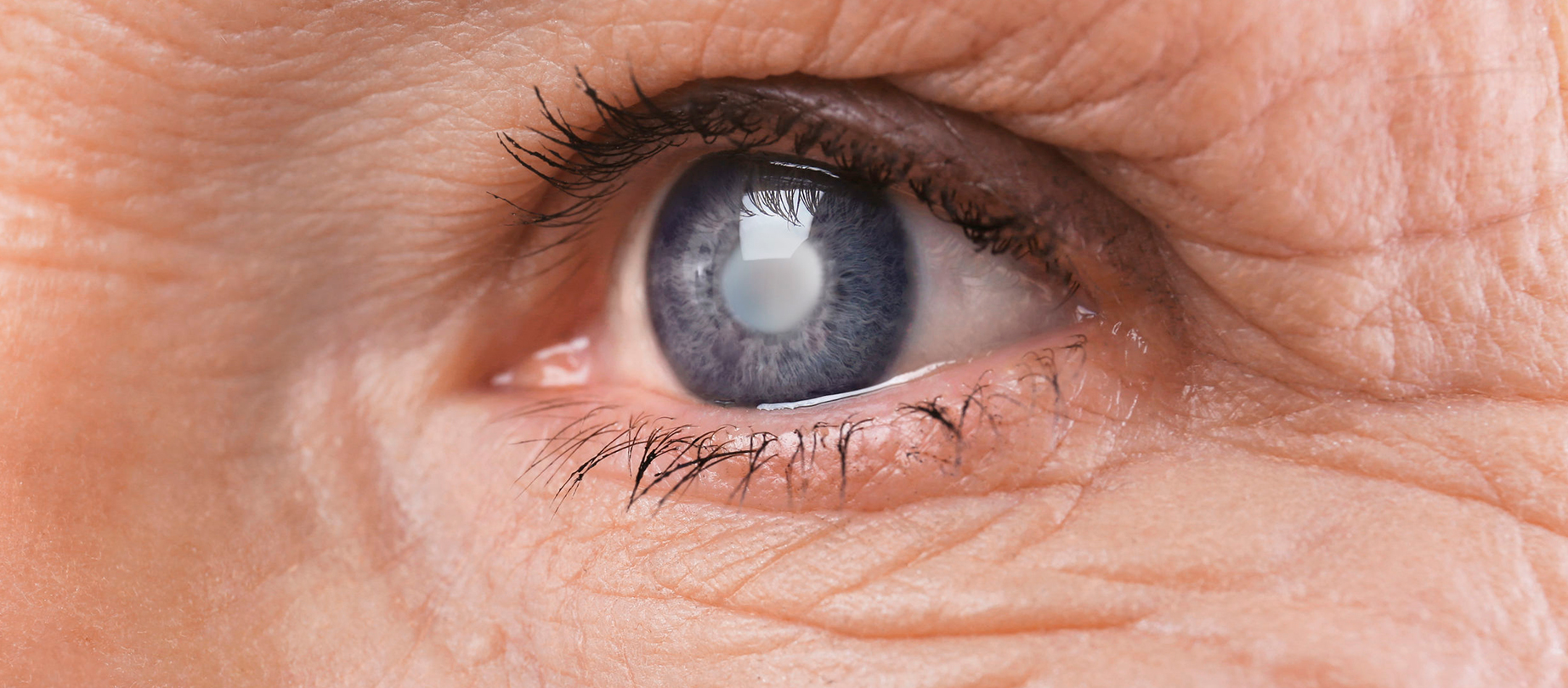 Prevent Cataract Surgery Naturally: Superfoods and Eye Exercises for Healthy Eyes