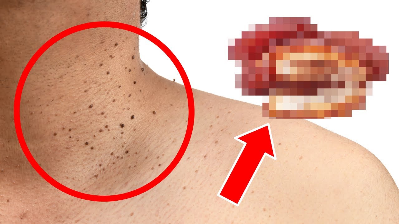 The Surprising Culprit Behind Skin Tags: One Common Food to Watch Out For